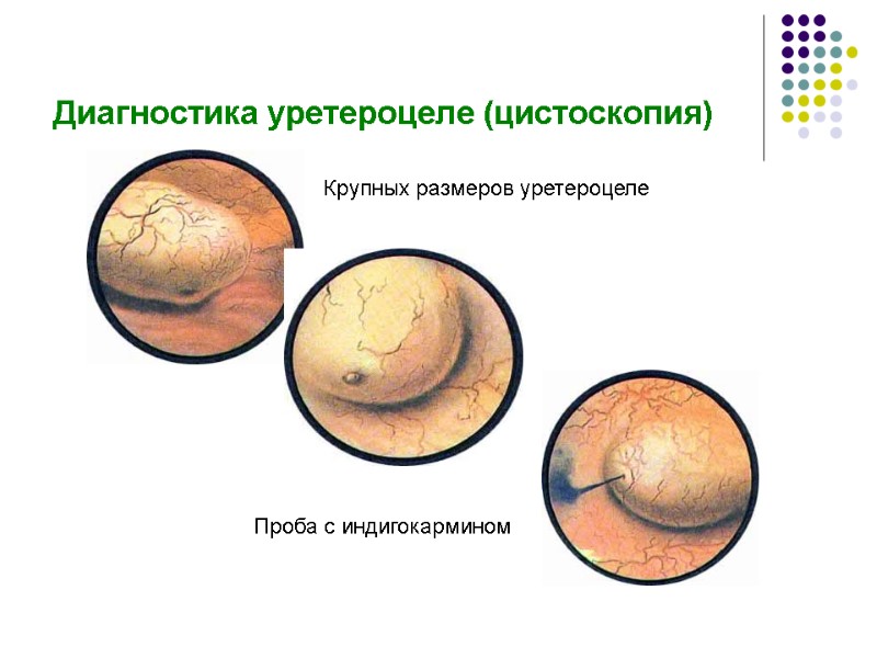 Диагностика уретероцеле (цистоскопия) Проба с индигокармином Крупных размеров уретероцеле